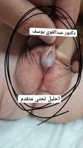 الجنس المبهم .الاحليل التحتي المتقدم